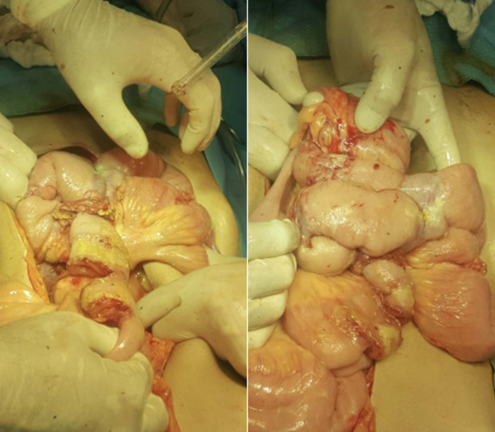 intraoperatively seen ileal perforations