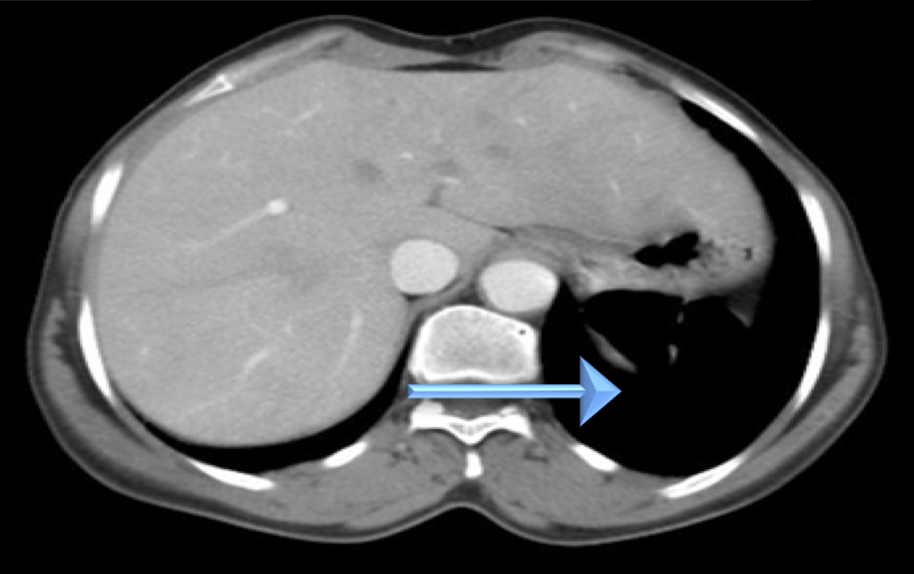 Wandering Spleen; abscence of the spleen in the left hypochondrium