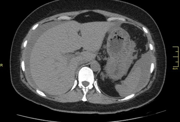 CT scan shows the presence of hemorrhage in the Morison's pouch