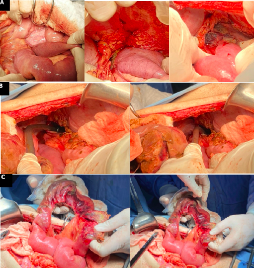 Diaphragmatic Hernia Intraoperative Images