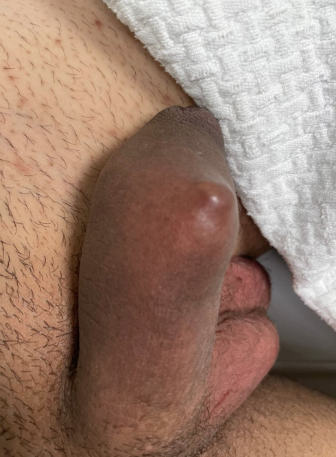 Penile lesion – Initial presentation