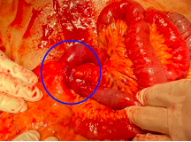 Exploratory Laparotomy showing dense adhesions involving stenotic jejunum.