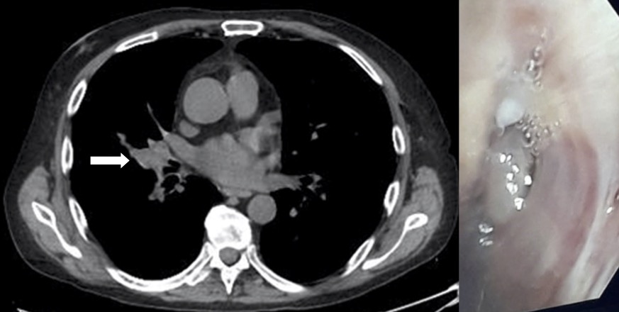 Pleomorphic Adenoma