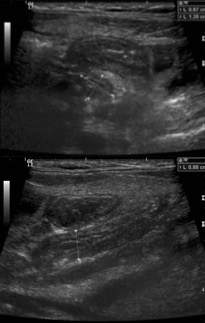 Initial radiologic findings suggestive of uncomplicated appendicitis. An enlarged appendix in a subcecal location showing a posteriorly ascending configuration can be visualized; it shows a thick wall, reaching a diameter of 9mm, containing minimal amount of intraluminal fluid at its tip with associated appendicolith measuring 8mm. 